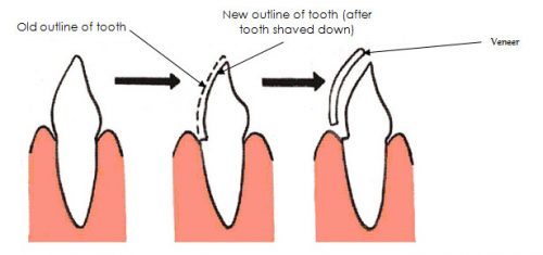 Dentall veneers