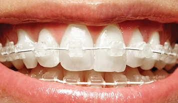 What do fixed ceramic braces look like