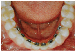 Lingual Orthodontics