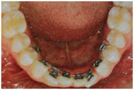 What do lingual braces look like
