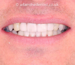 After dental veneers