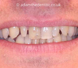 Before dental veneers