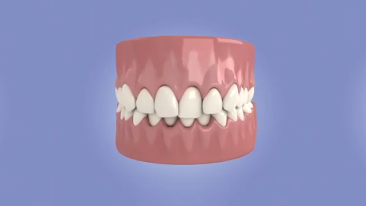 Inman Aligner