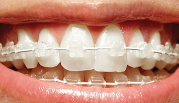 Fixed Ceramic Braces